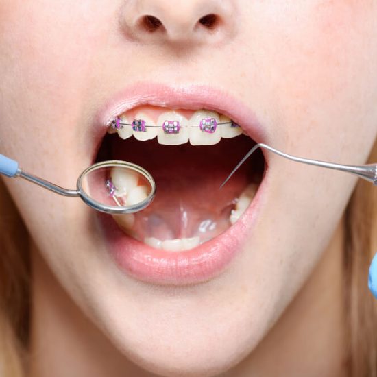 Can you wear braces with baby teeth?