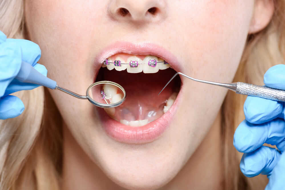 Can you wear braces with baby teeth?