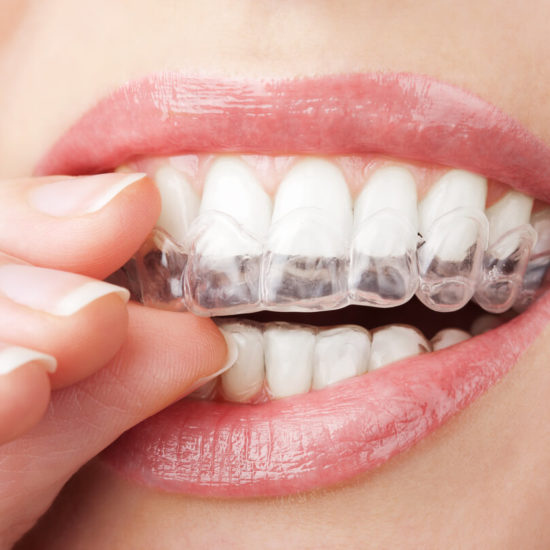 Does Teeth Whitening Work on Fillings?